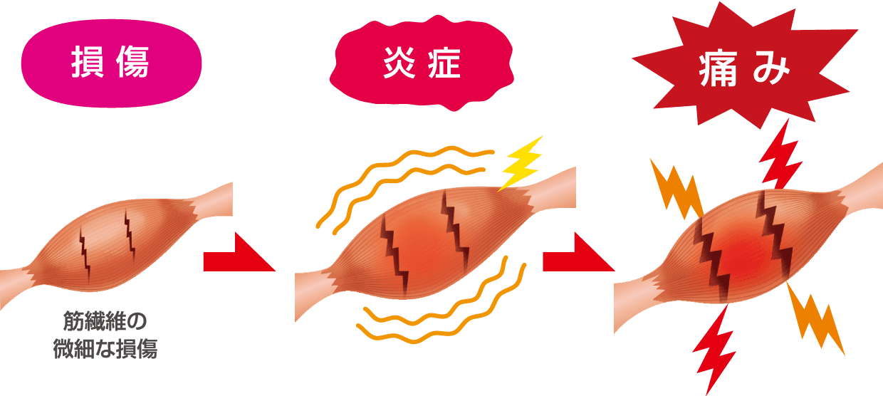 損傷 筋繊維の微細な損傷→炎症→痛み